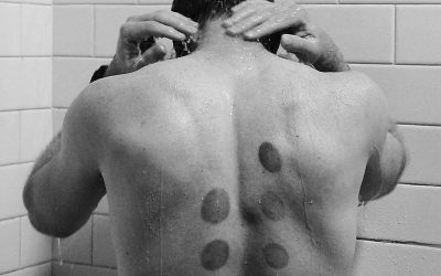 3 reasons to try cupping and Hijama