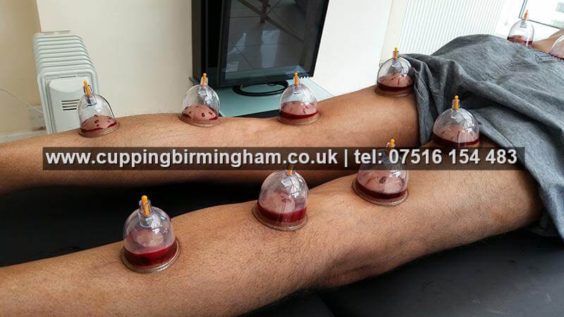 Hijama Cupping as Therapy and Medicine