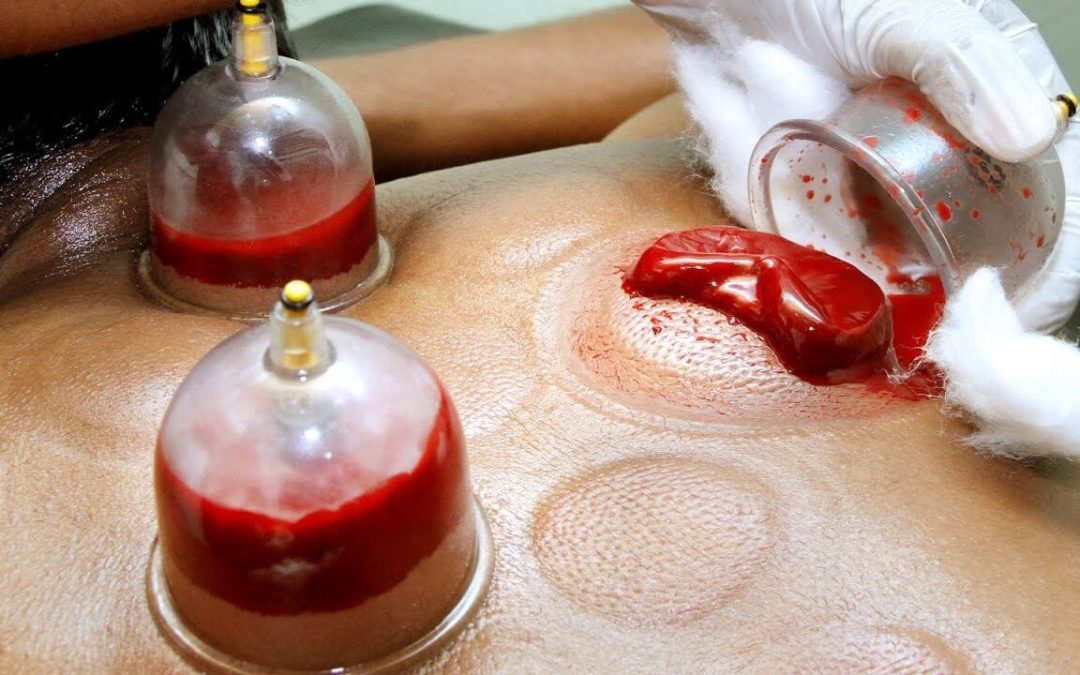 5 Things You Should Know About Hijama Cupping