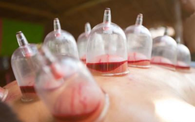 7 Benefits of Wet Cupping
