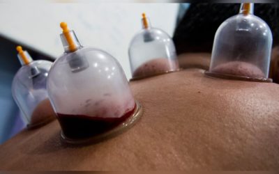 Difference Between Wet and Dry Cupping