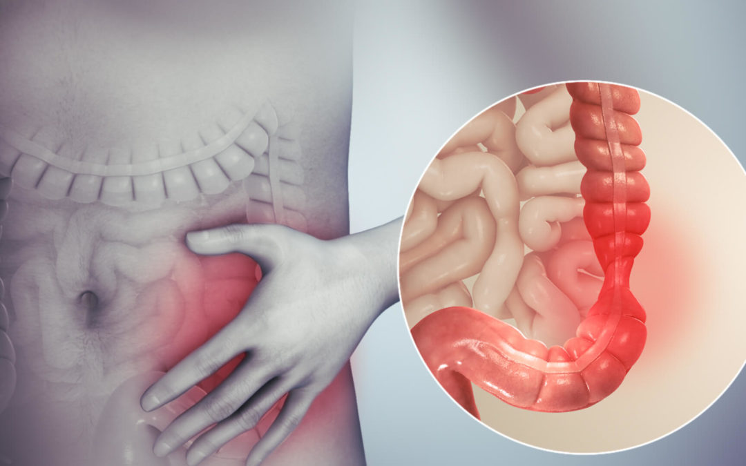Hijama Cupping For Irritable Bowel Syndrome & Other Digestive Disorders (IBS)