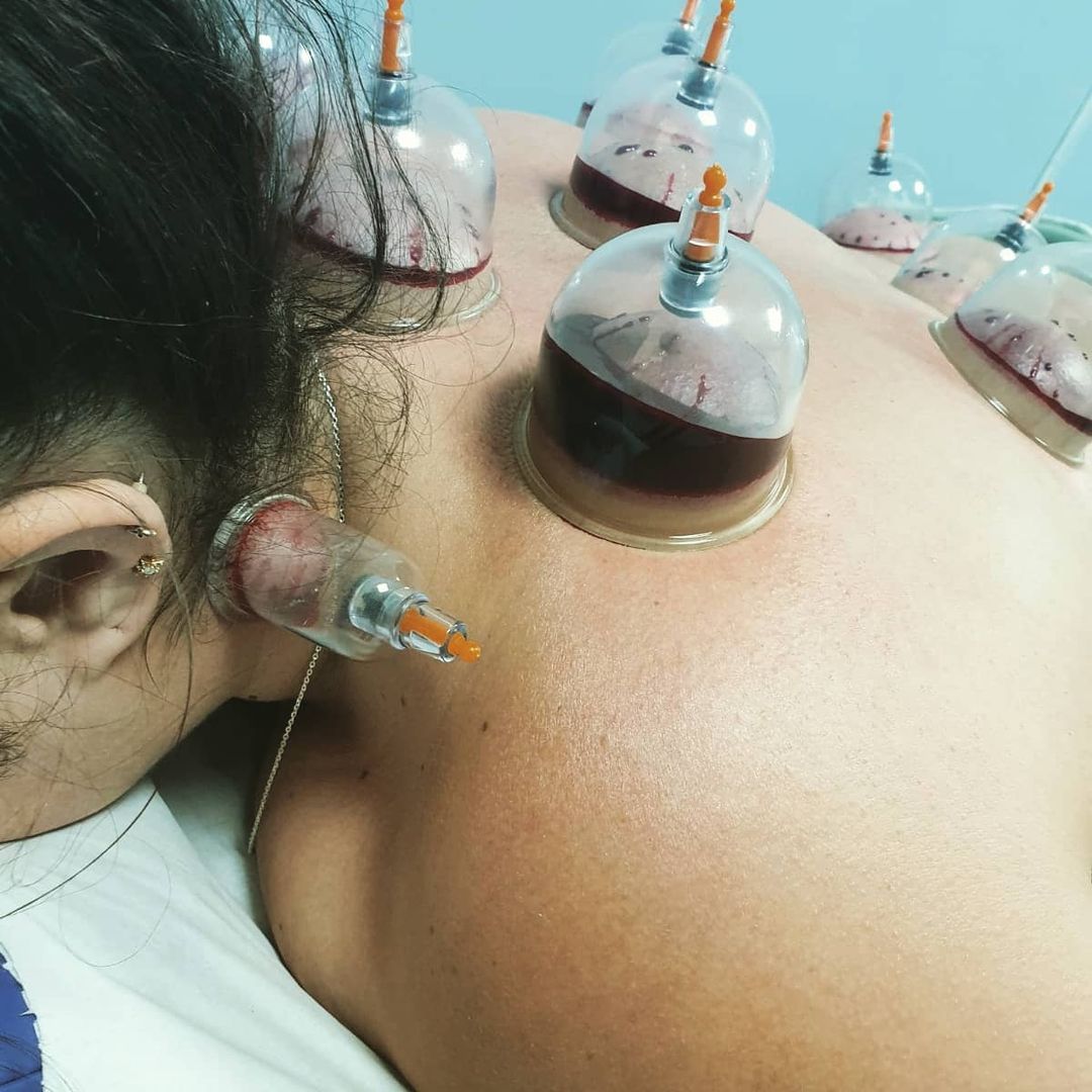 female hijama cupping birmingham