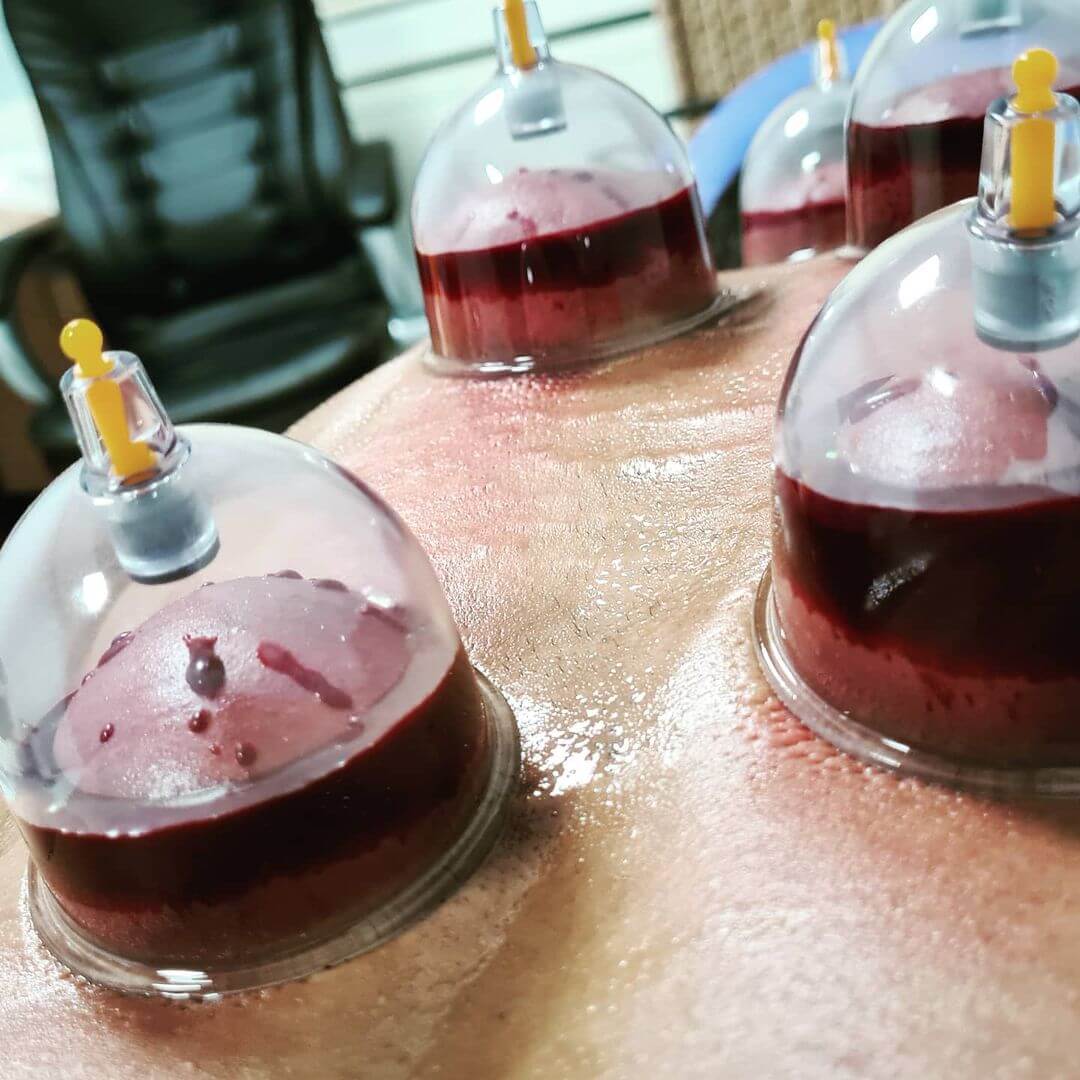 cupping birmingham hijama