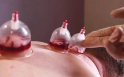 What is Hijama Cupping Therapy?