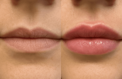 prf lips