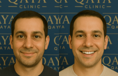 prf under eyes